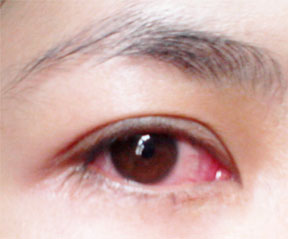 sore eye