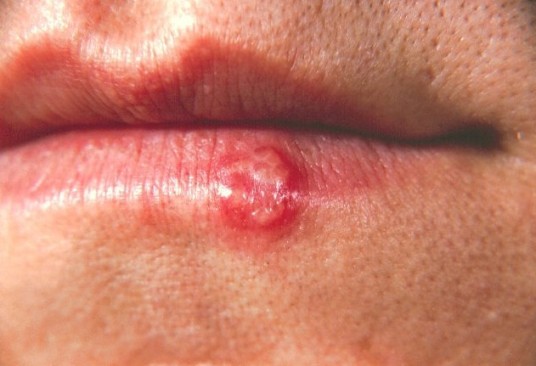 fordyce granules on lips