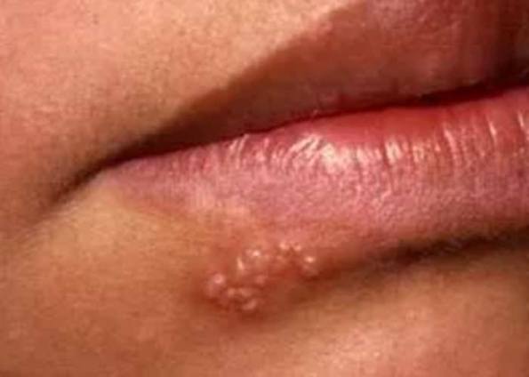 Lips on small bumps tiny Fordyce Spots