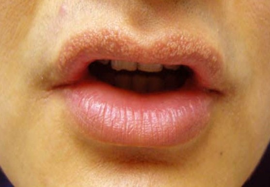 small white bumps on lips