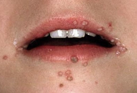 white bumps on hpv lips