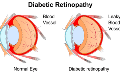 Diabetic Retinopathy – Vitamin Resource