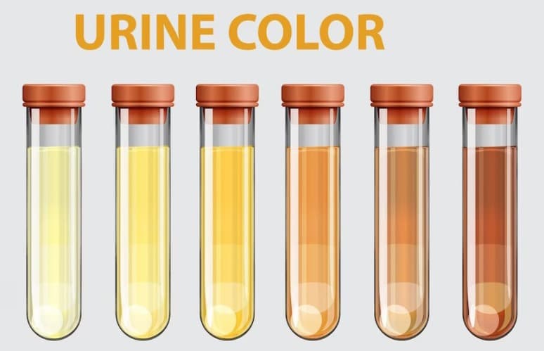 What Causes Dark Brown Urine