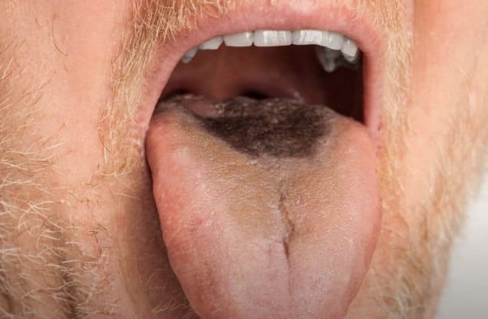 Black Tongue in Elderly